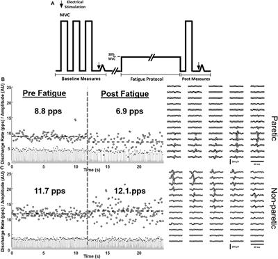 Impaired Firing Behavior of Individually Tracked Paretic Motor Units During Fatiguing Contractions of the Dorsiflexors and Functional Implications Post Stroke